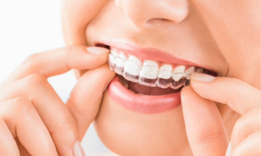 Invisalign braces in Thane