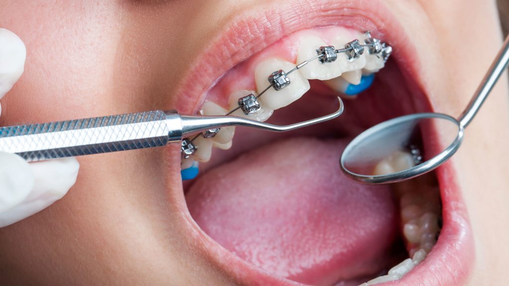 Best orthodontist in thane